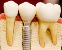 Implantes Dentales: La Solución Eficaz para Recuperar Tu Sonrisa